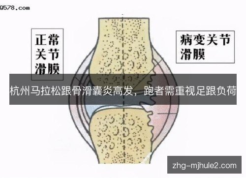 杭州马拉松跟骨滑囊炎高发,跑者需重视足跟负荷 杭州马拉松跟骨滑囊炎高发,跑者需重视足跟负荷
